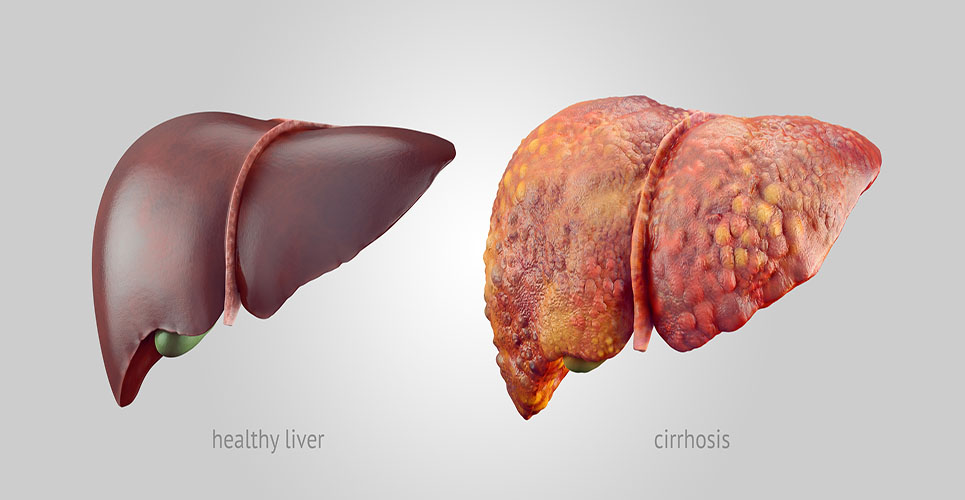 Nonalcoholic fatty liver disease: drug treatments