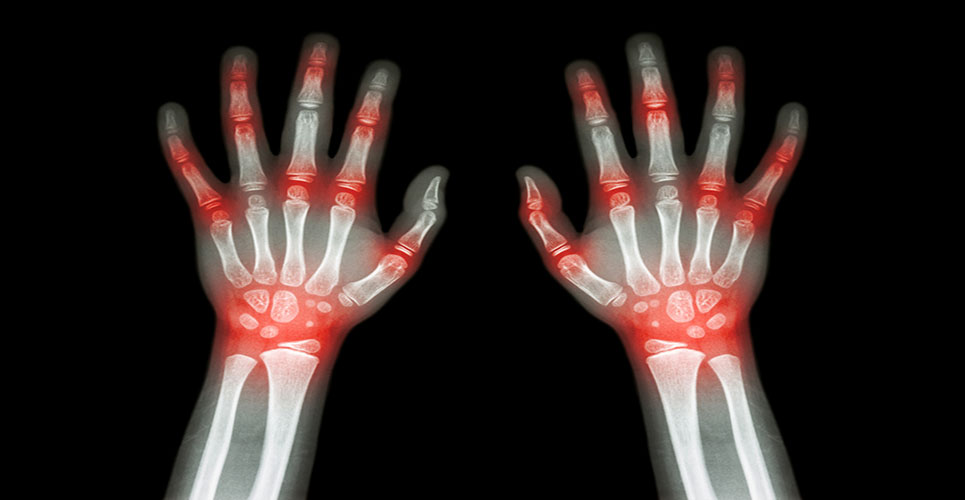 Adalimumab biosimilar approved in Europe for the treatment of multiple chronic inflammatory diseases