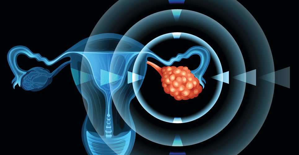 Another treatment option for ovarian cancer approved for the Cancer Drugs Fund
