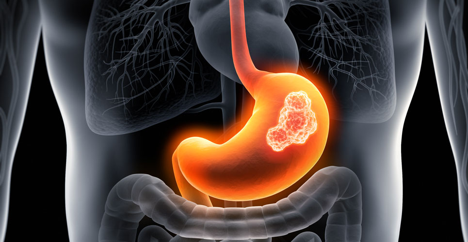 Apatinib neoadjuvant therapy effective for advanced gastric cancer