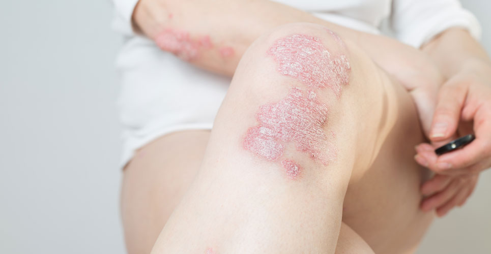 Bimekizumab approved in EU for moderate to severe psoriasis