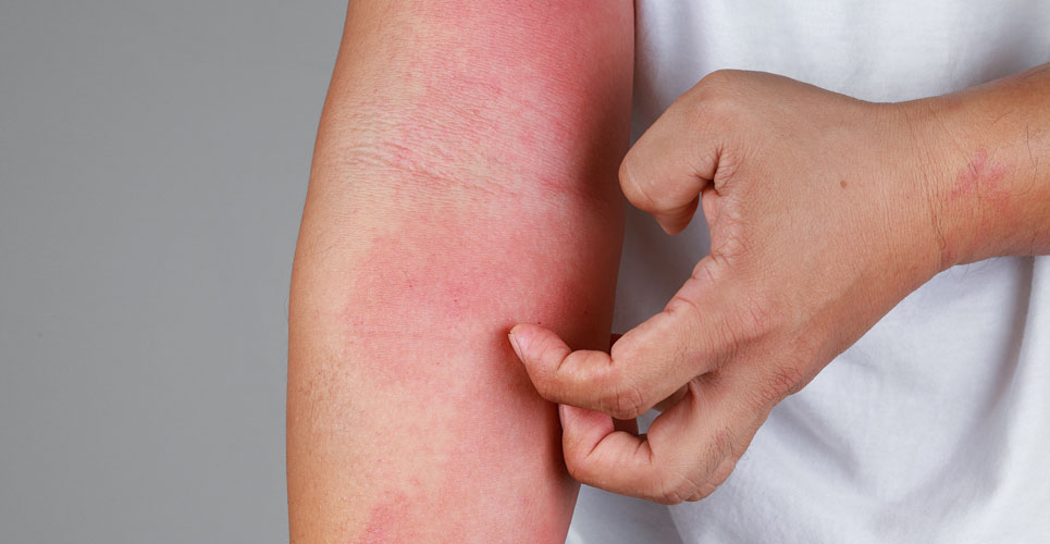 Atopic eczema patient outcomes improved by dupilumab in everyday clinical practice