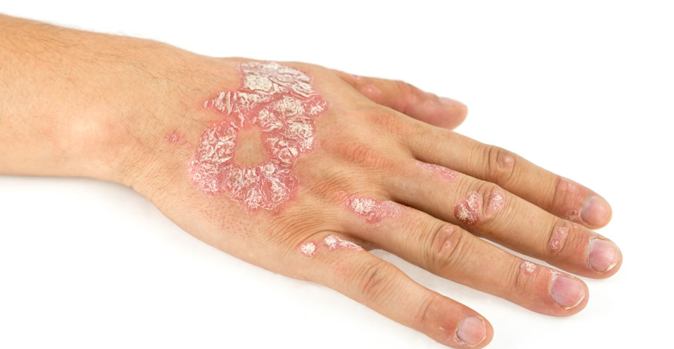 Cosentyx recommended for children and young people with psoriasis