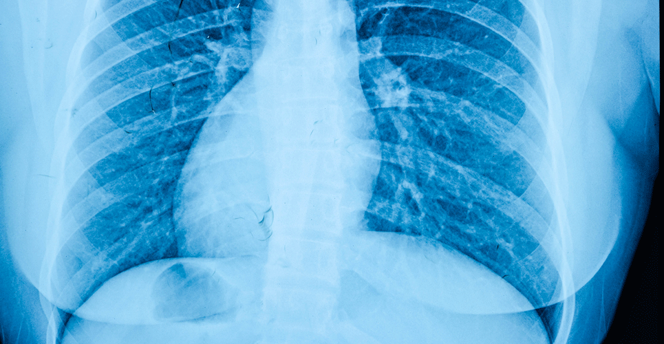 Dark field X-ray identifies emphysema  in COPD patients