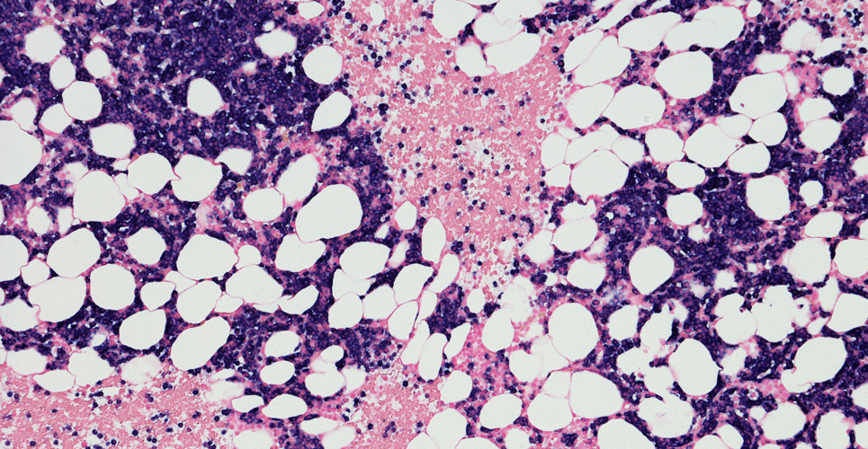 multiple myeloma cells