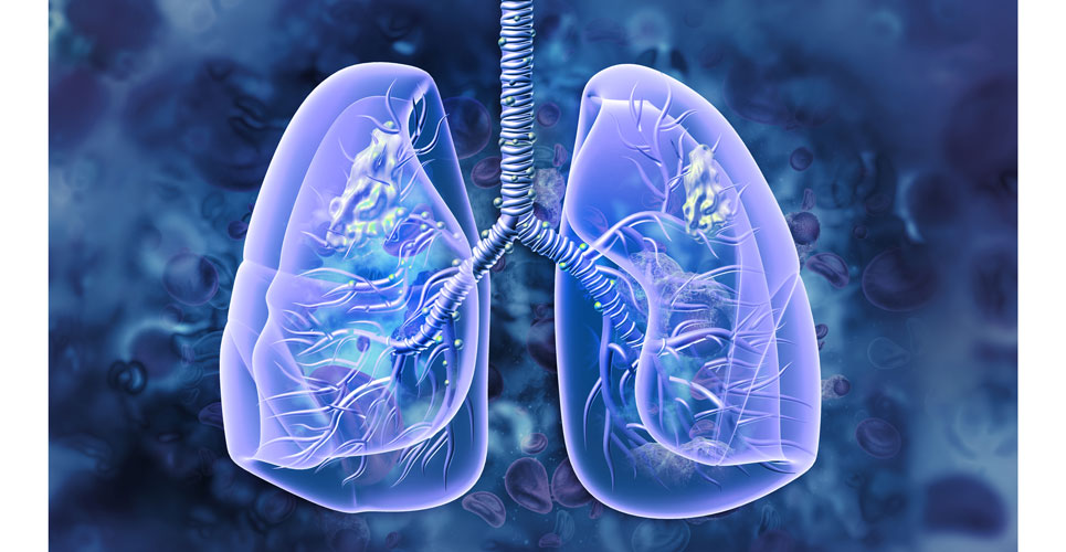 Standalone AI reader could reduce radiologist workload in lung cancer screening