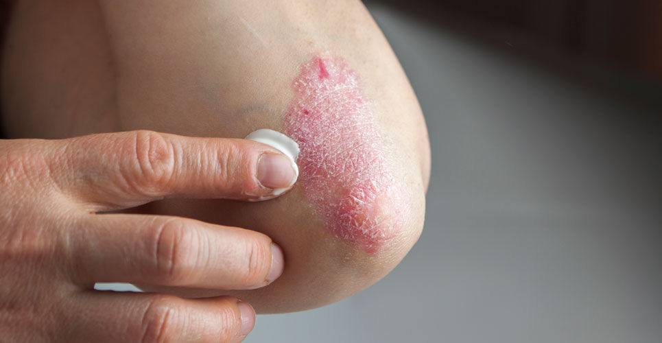 Psoriasis patients report higher analgesic use due to joint pain