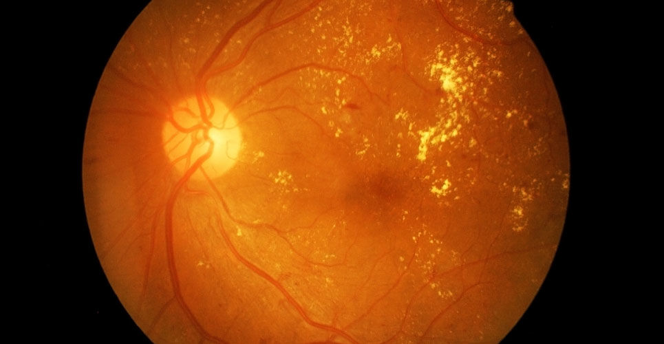 Fenofibrate use associated with lower risk of vision-threatening diabetic retinopathy