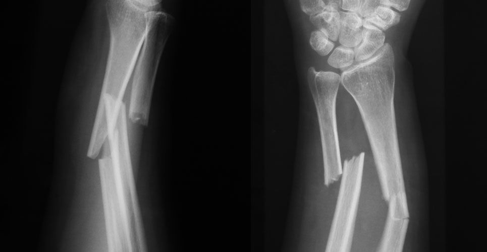 Rates of fracture detection found to be comparable between AI and clinicians