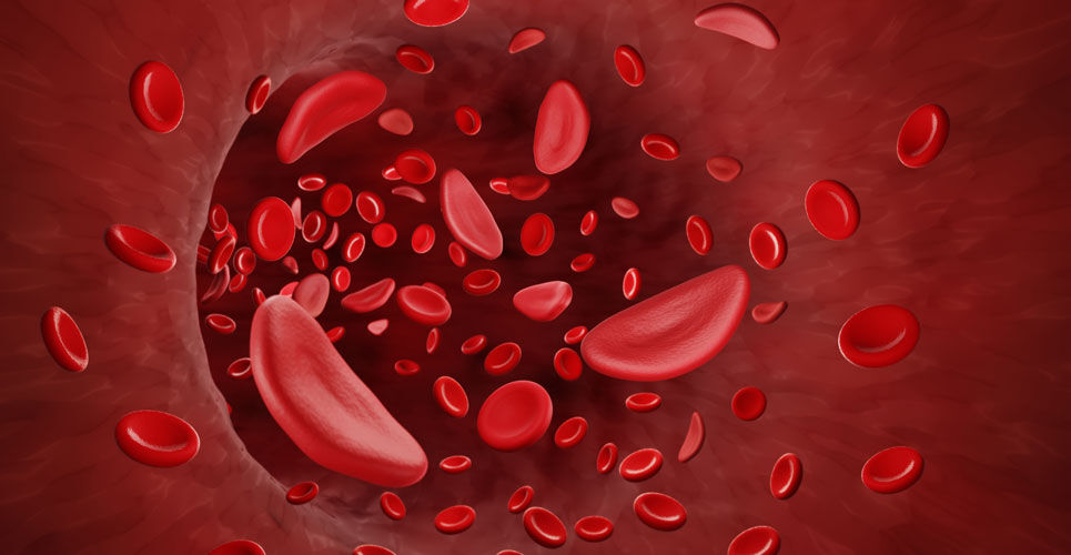 Study finds systemic corticosteroid use increases risk of hospitalisation for vaso-occlusive episodes in sickle cell disease