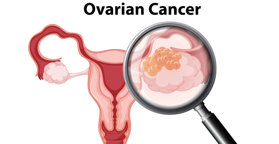 Apatinib addition to doxorubicin improves outcomes in platinum-resistant recurrent ovarian cancer