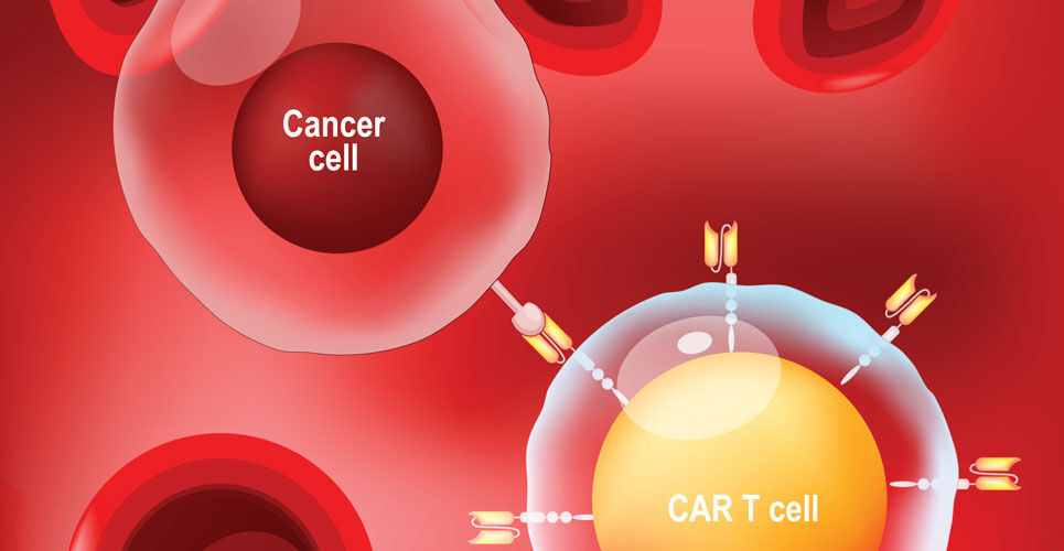 Next day CAR T cells process effective in acute lymphoblastic leukaemia