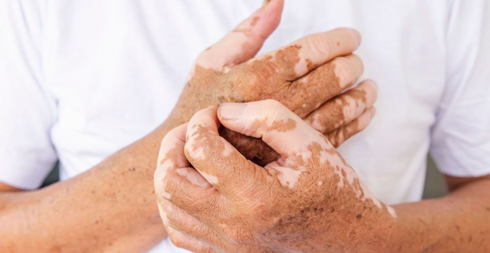 Ruxolitinib cream approved by FDA for vitiligo