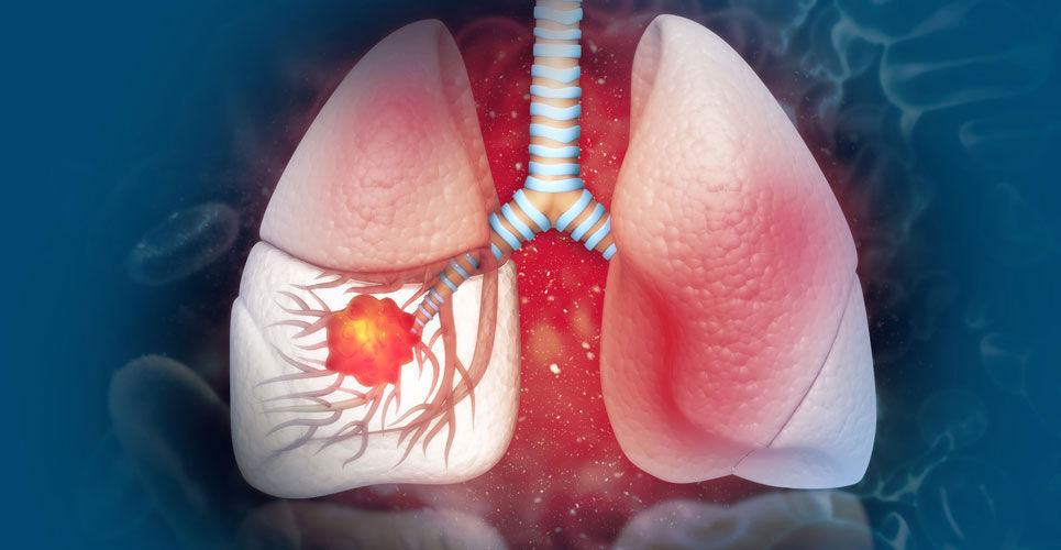 Canakinumab trial data in non-small cell lung cancer released