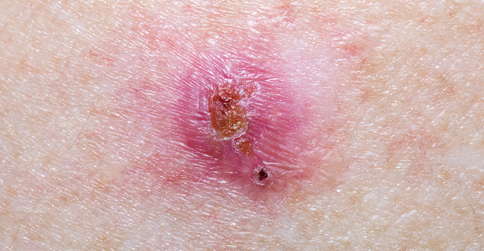 Basal cell carcinoma diagnosis improved upon with novel imaging technique