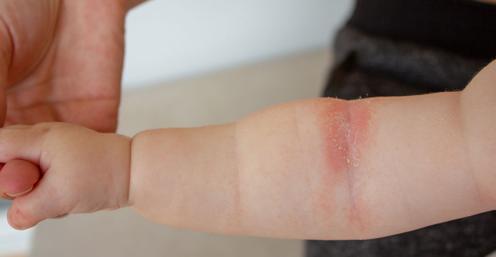 Dupilumab effective in children under six with atopic eczema