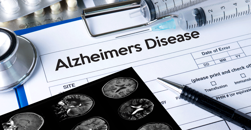 Early Alzheimer’s decline in cognition slowed by lecanemab