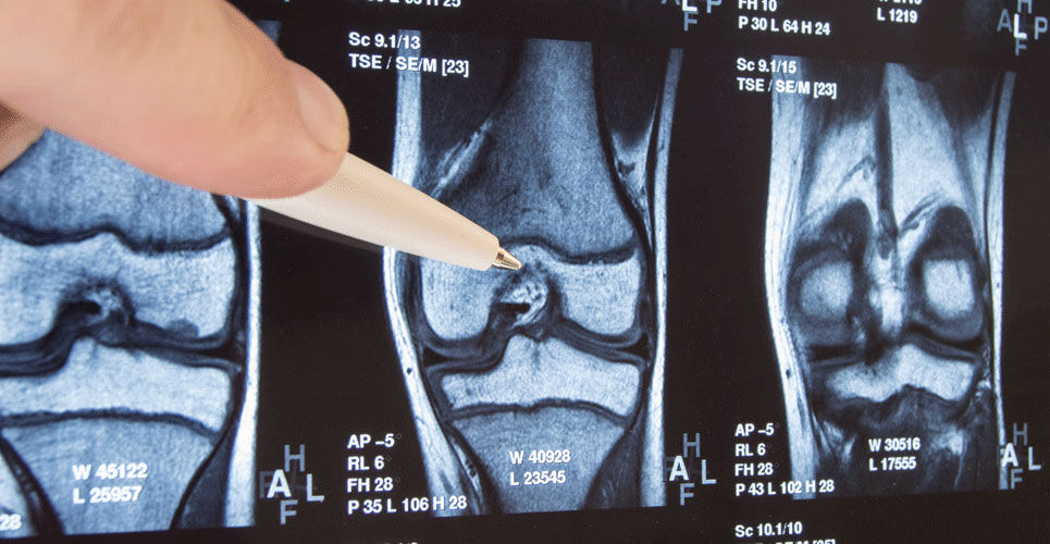 MRI study finds NSAIDs worsen arthritis inflammation with long-term use