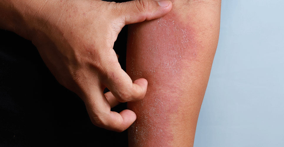 Lebrikizumab combined with topical steroids effective for moderate to severe atopic eczema