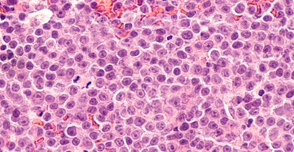 NICE approves Yescarta for relapsed/remitted lymphomas