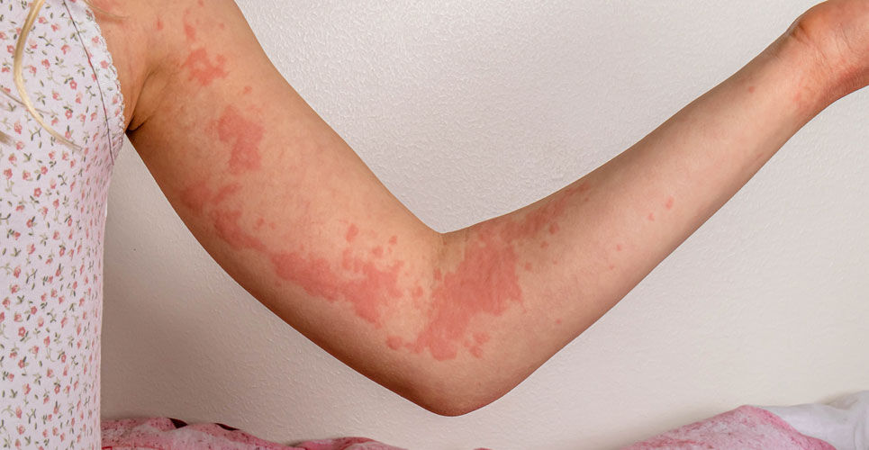 Dupilumab treatment reduces spontaneous chronic urticaria activity and improves quality of life