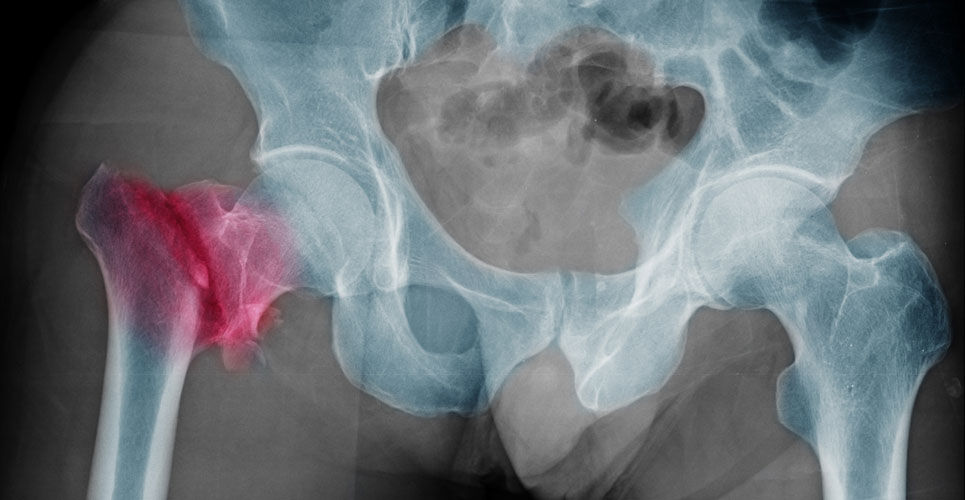 AI model diagnostic performance for hip fractures broadly similar to expert clinicians