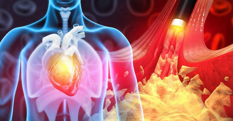 Both types of cardiovascular disease (CVD) linked to higher risk of ...