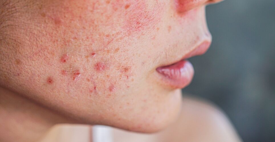 Study confirms spironolactone safe and effective for treating acne in women