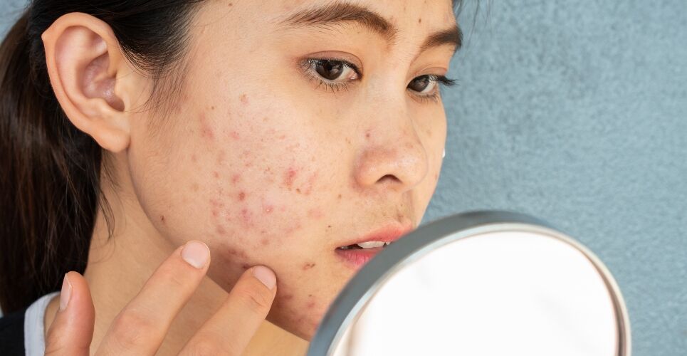 Local adverse effects from topical acne therapy significantly reduced with ceramide routine