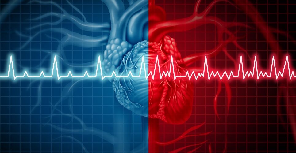 Stroke risk reduced in people with both diabetes and atrial fibrillation via SGLT-2 inhibitor use