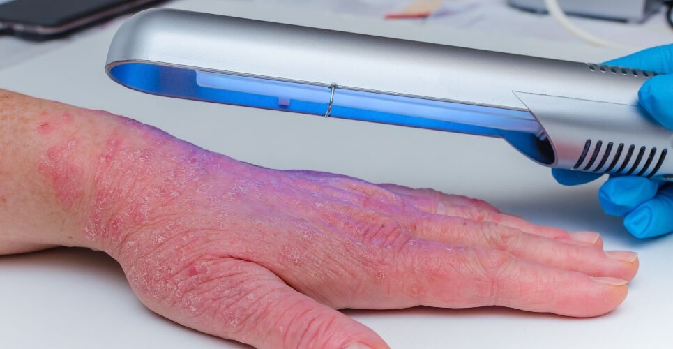 UVB phototherapy for atopic eczema does not increase skin cancer risk, says study