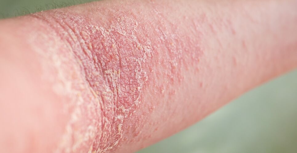 Amlitelimab use in moderate to severe atopic dermatitis improves disease severity