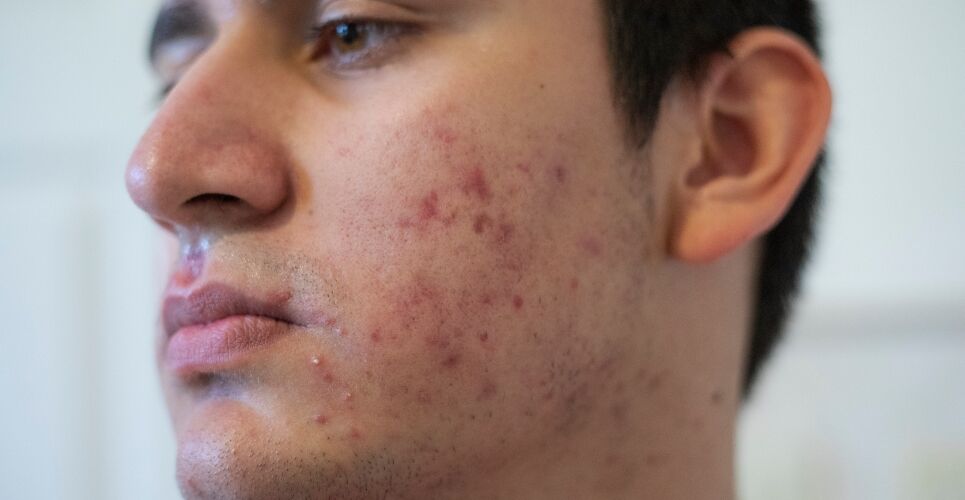 Network meta-analysis confirms oral isotretinoin as most effective acne treatment