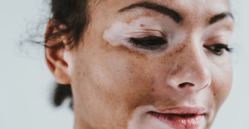 Ruxolitinib cream gains MHRA approval for non-segmental vitiligo