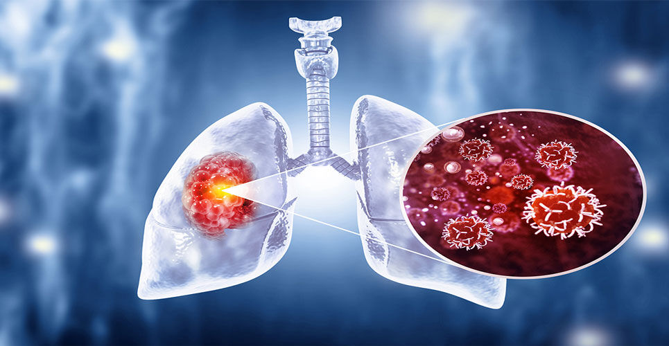 Perioperative pembrolizumab improves outcomes in early-stage NSCLC