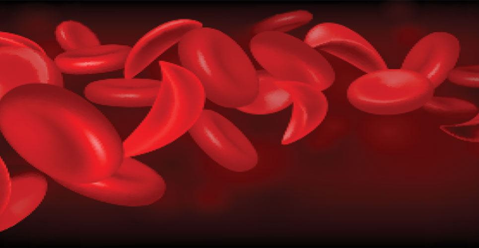 Stem cell gene therapy appears to offer effective curative treatment for sickle cell disease
