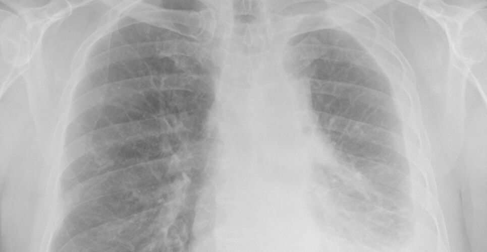 Innovative combination treatment significantly improves survival in pleural mesothelioma