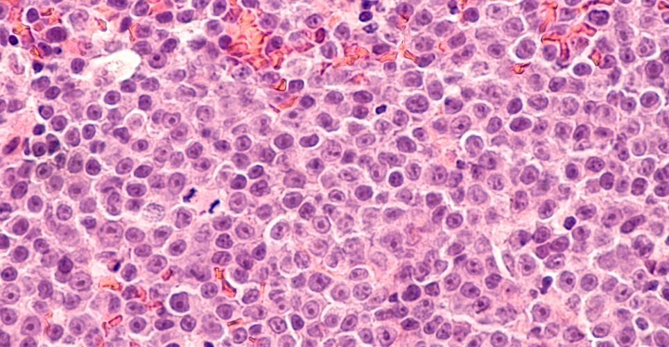NICE recommends efpcoritamab for diffuse large B-cell lymphoma after two or more lines of treatment