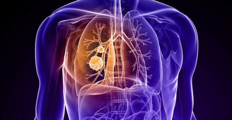 Tislelizumab receives positive CHMP opinion for non-small cell lung cancer