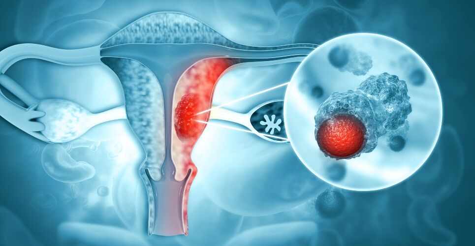 NICE recommends dostarlimab as first-line combination treatment for endometrial cancer